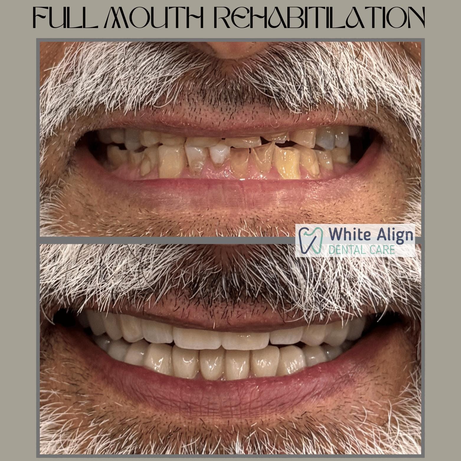 Before and after treatment result at White Align Dental Care