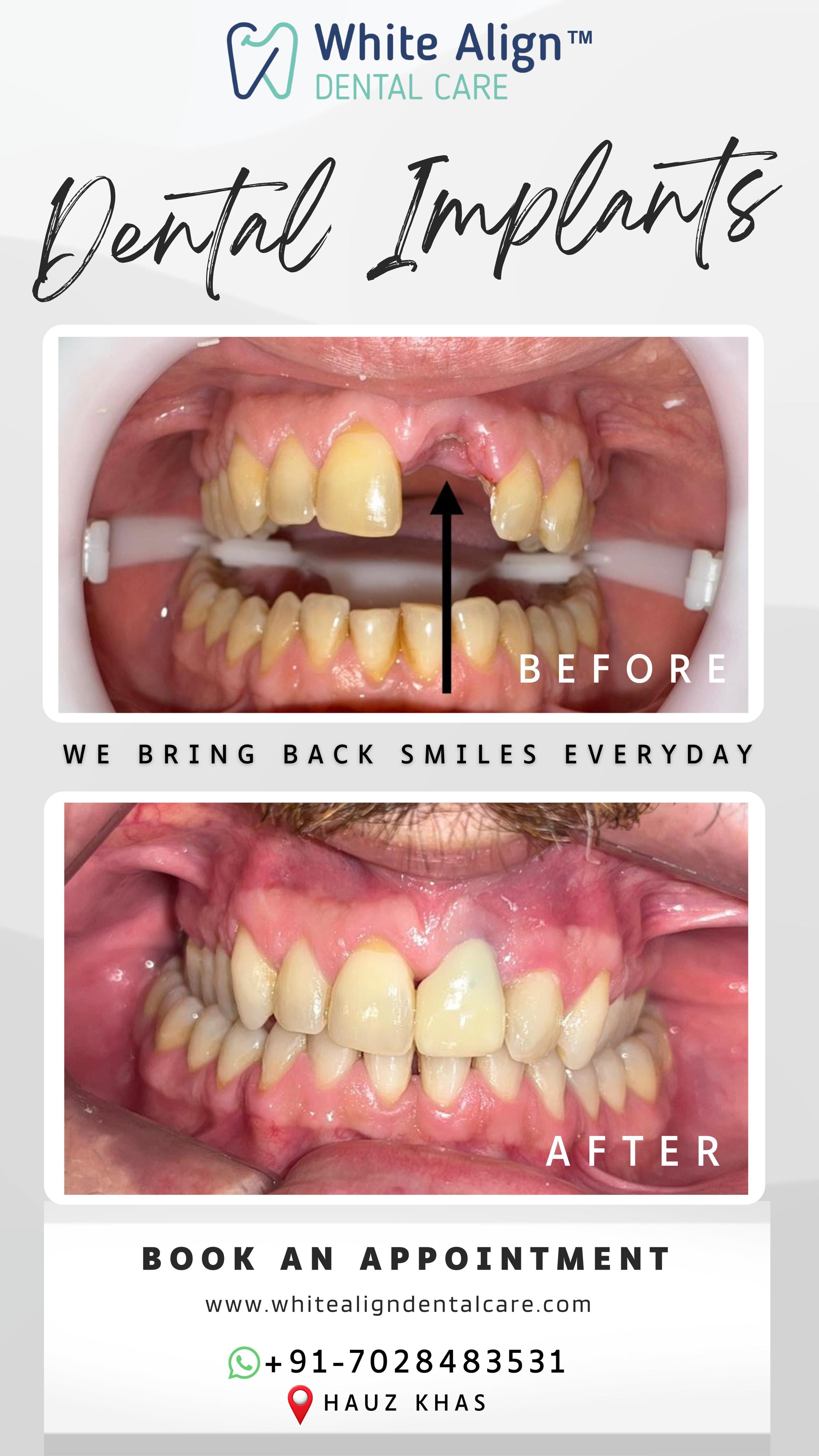 Before and after treatment result at White Align Dental Care