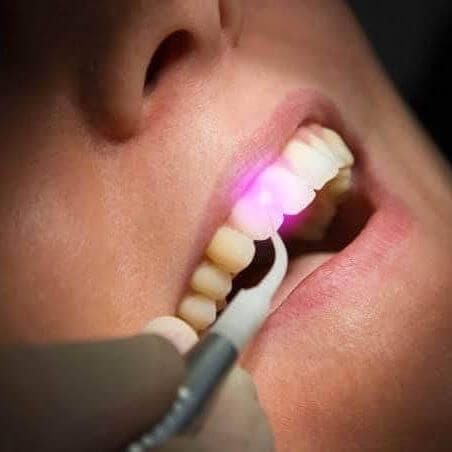 Laser Dentistry