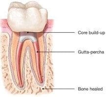 Root Canal Therapy